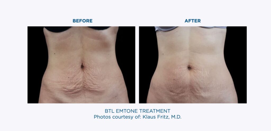 BTL-EMTONE-Stomach-Treatment