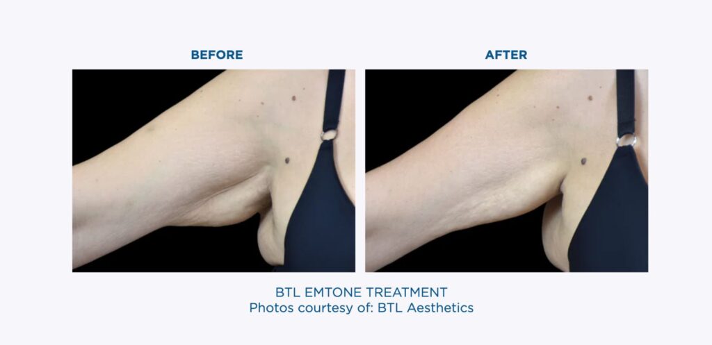 BTL-EMTONE-Underarm-Treatment