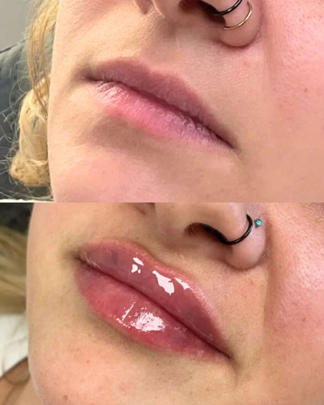 Before/after photo of a woman's lips.