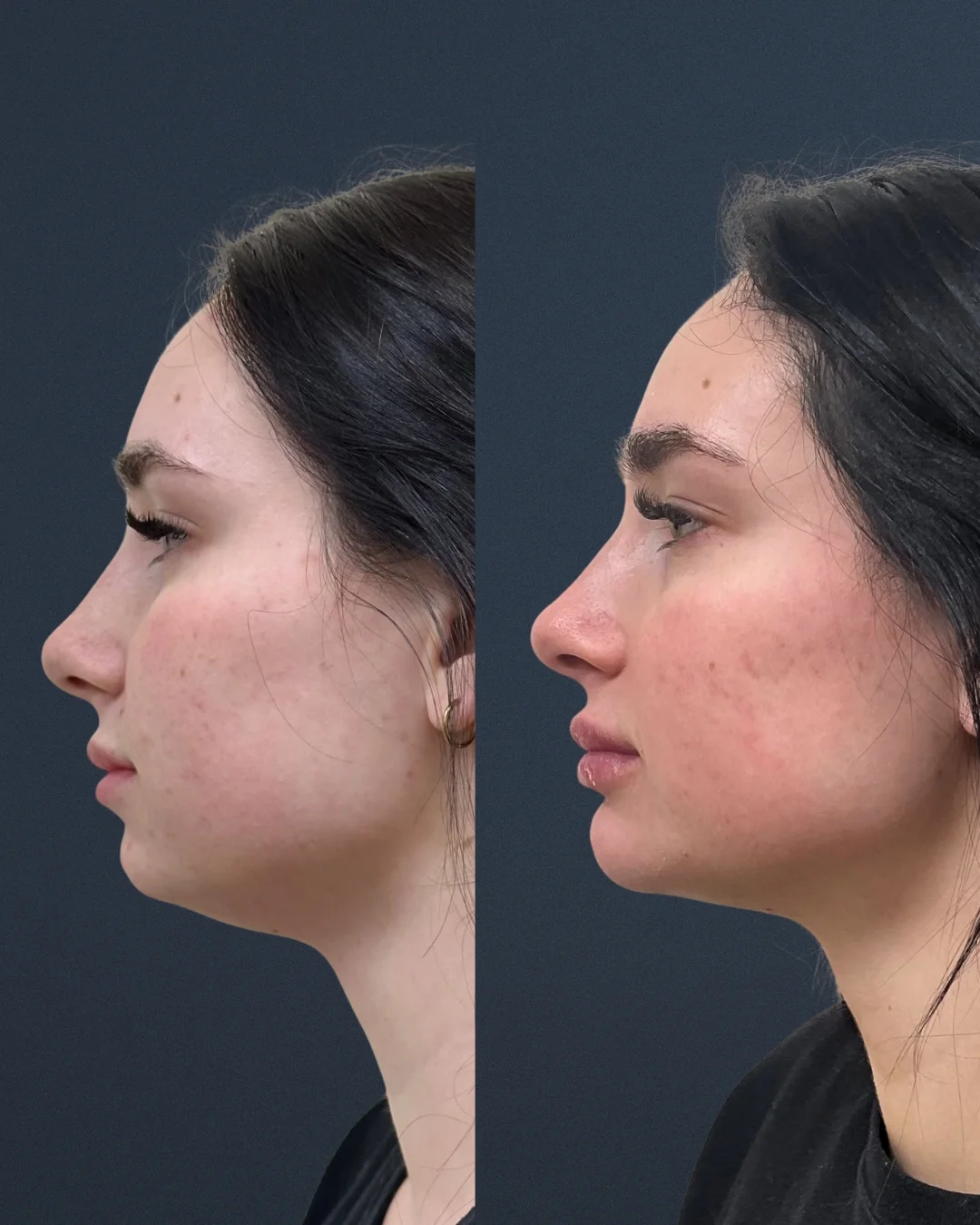 A before and after photo of a young woman's facial profile.