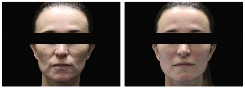 Emface-After-4th-Treatment-Courtesy-of-Joel-L.-Cohen-M.D