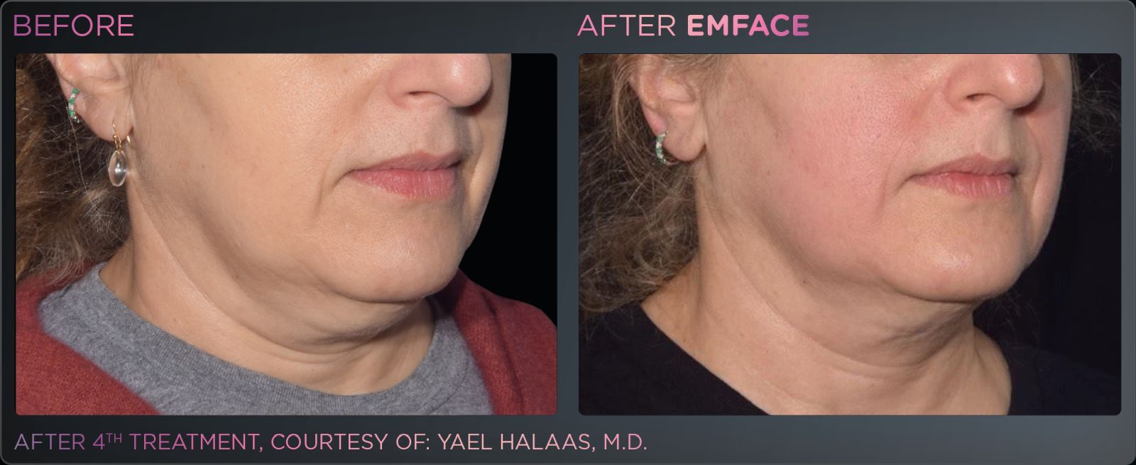 Before/after photo of a female jawline, showing positive results from Emface treatments.