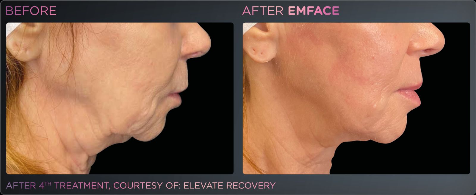 Before/after photo of a female jawline, showing positive results from Emface treatments.