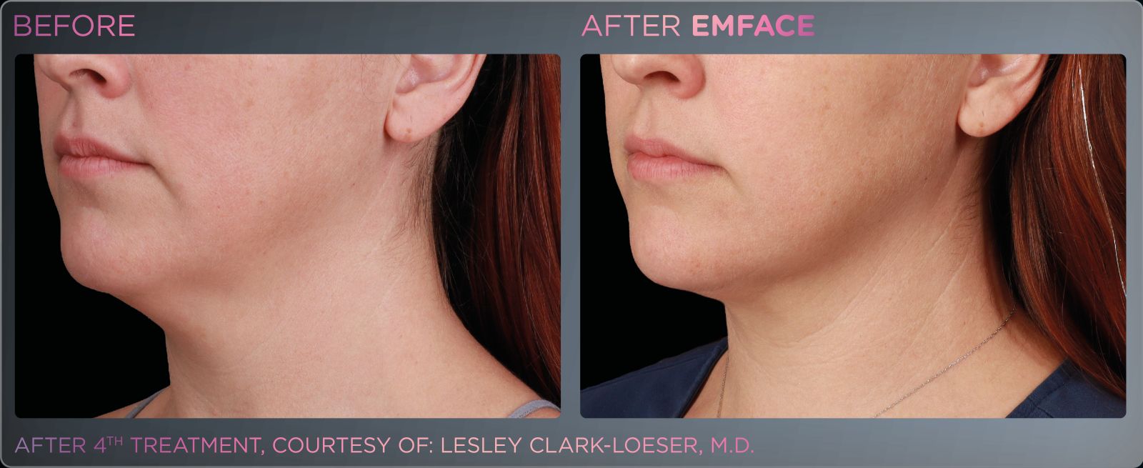 Before/after photo of a female chin and neck region, showing positive results from Emface treatments.