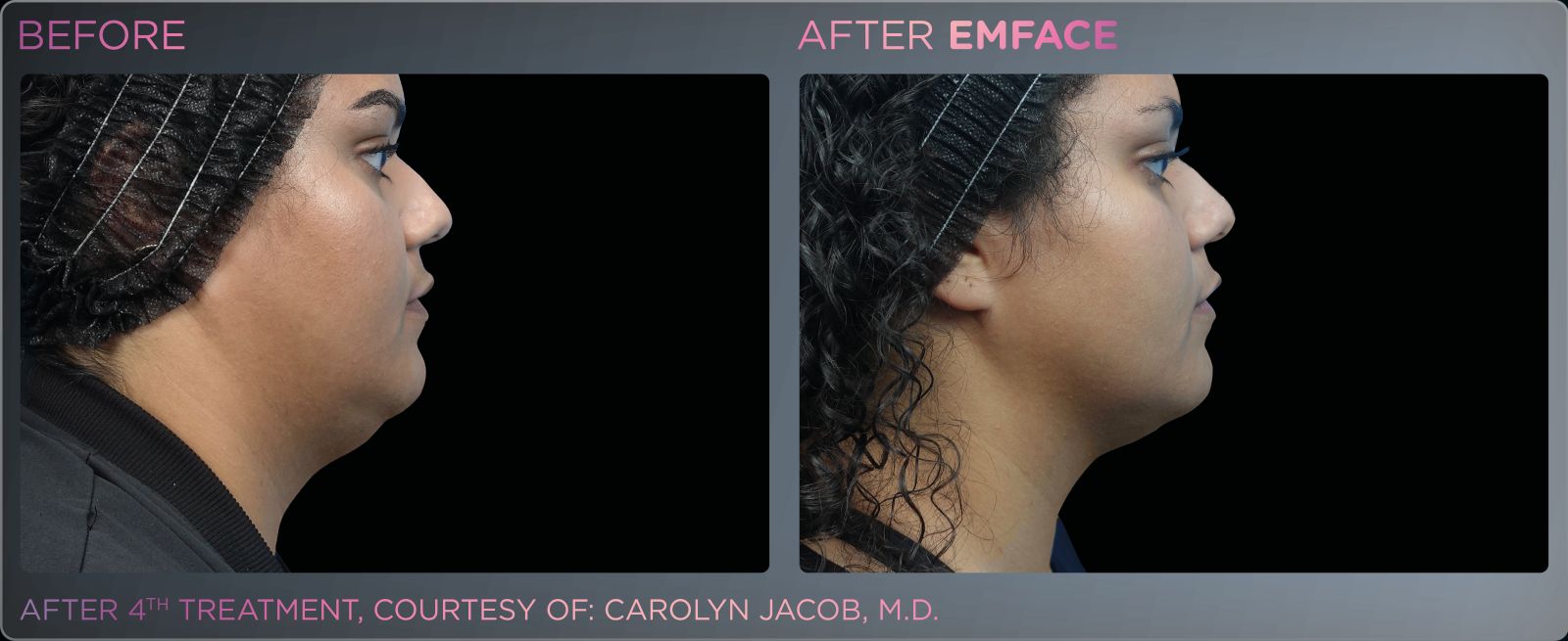 Before/after photo of a female chin and neck region, showing positive results from Emface treatments.