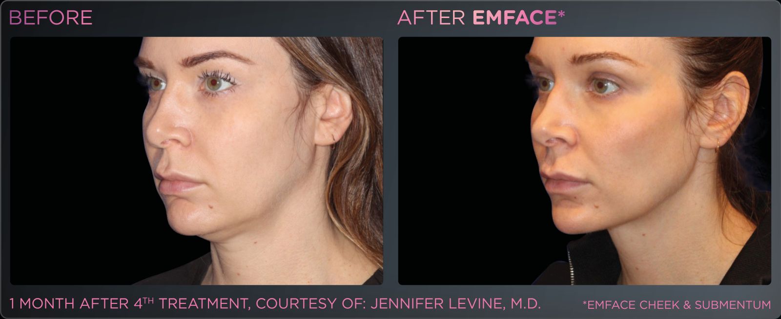 Before/after photo of a female chin and neck region, showing positive results from Emface treatments.