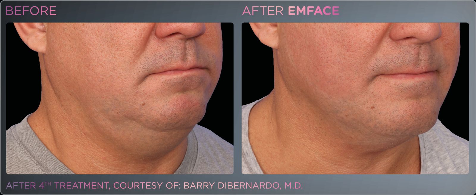 Before/after photo of a male chin and neck region, showing positive results from Emface treatments.
