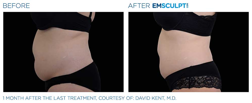 Before/after photo of a female abdomen region, showing positive results from the Emsculpt NEO treatments.