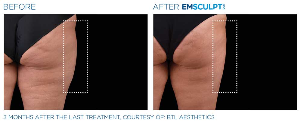 Before/after photo of a female thigh region, showing positive results from the Emsculpt NEO treatments.