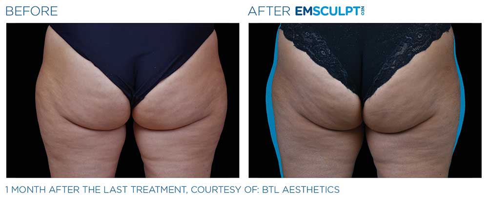Before/after photo of a female thigh region, showing positive results from the Emsculpt NEO treatments.