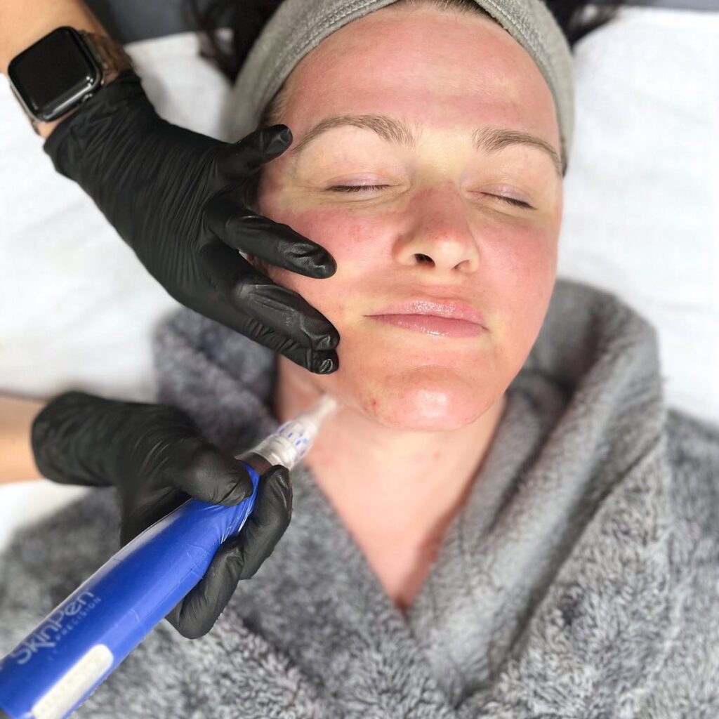 A technician wearing black gloves uses a SkinPen device on a client's face.