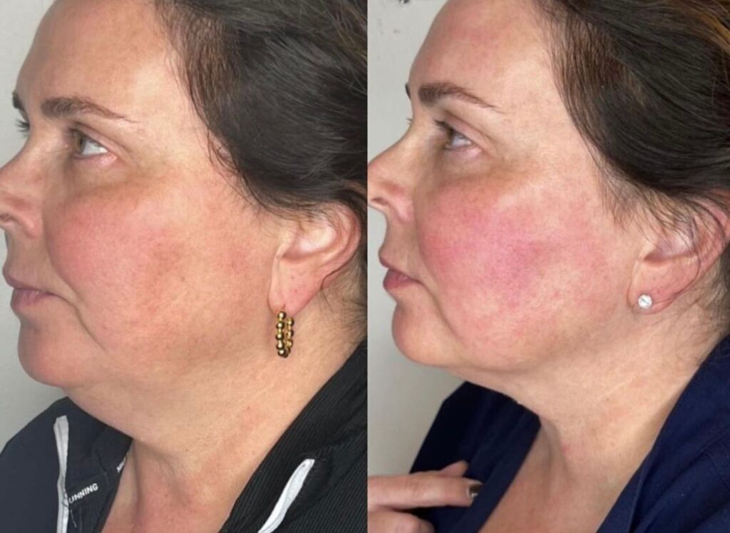 Emface Results by Laurel, Licensed Medical Aesthetician (IG: studiosculptlaurel)