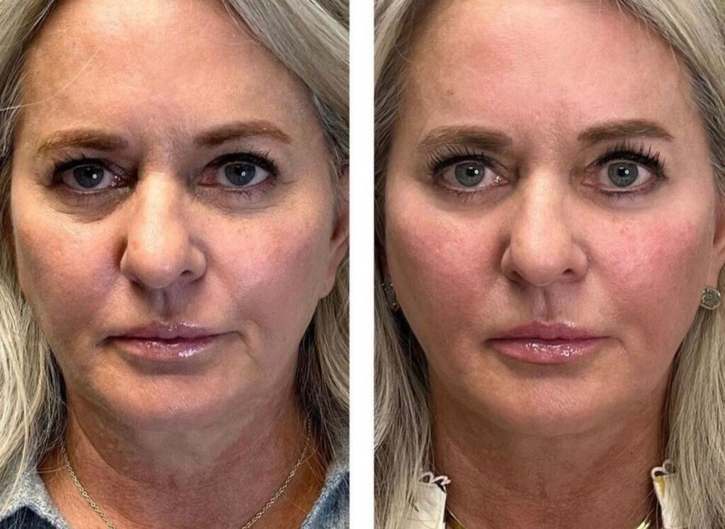 Emface after 4 treatments by Alazzo Med Spa
