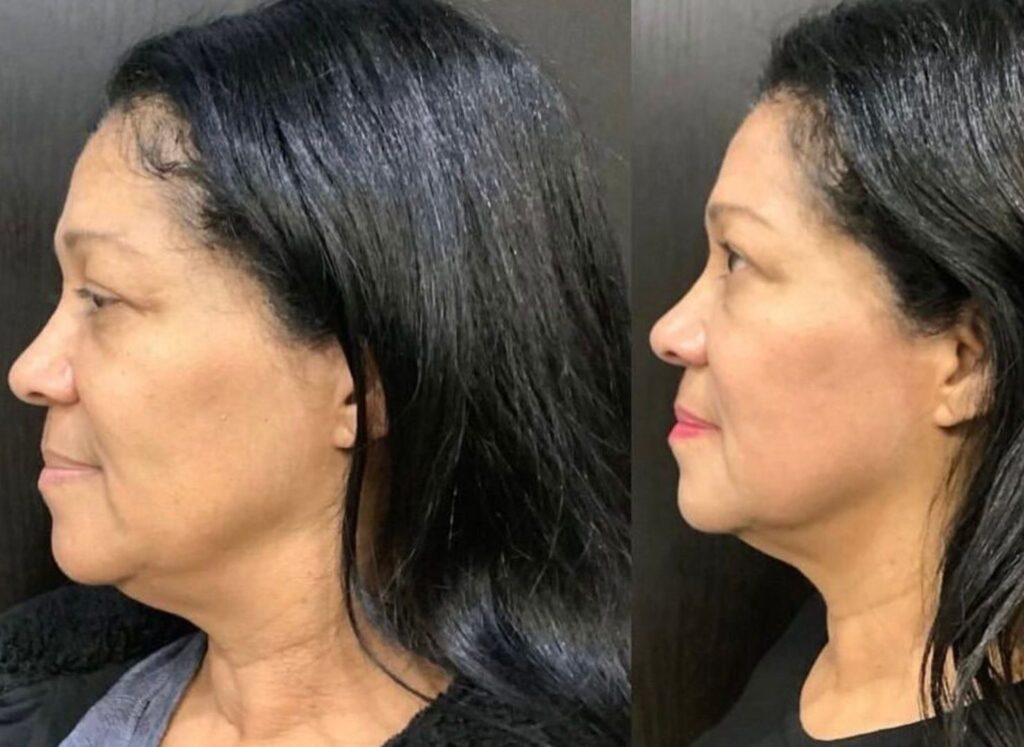 Emface results via BOYD-Dr. Charles Boyd