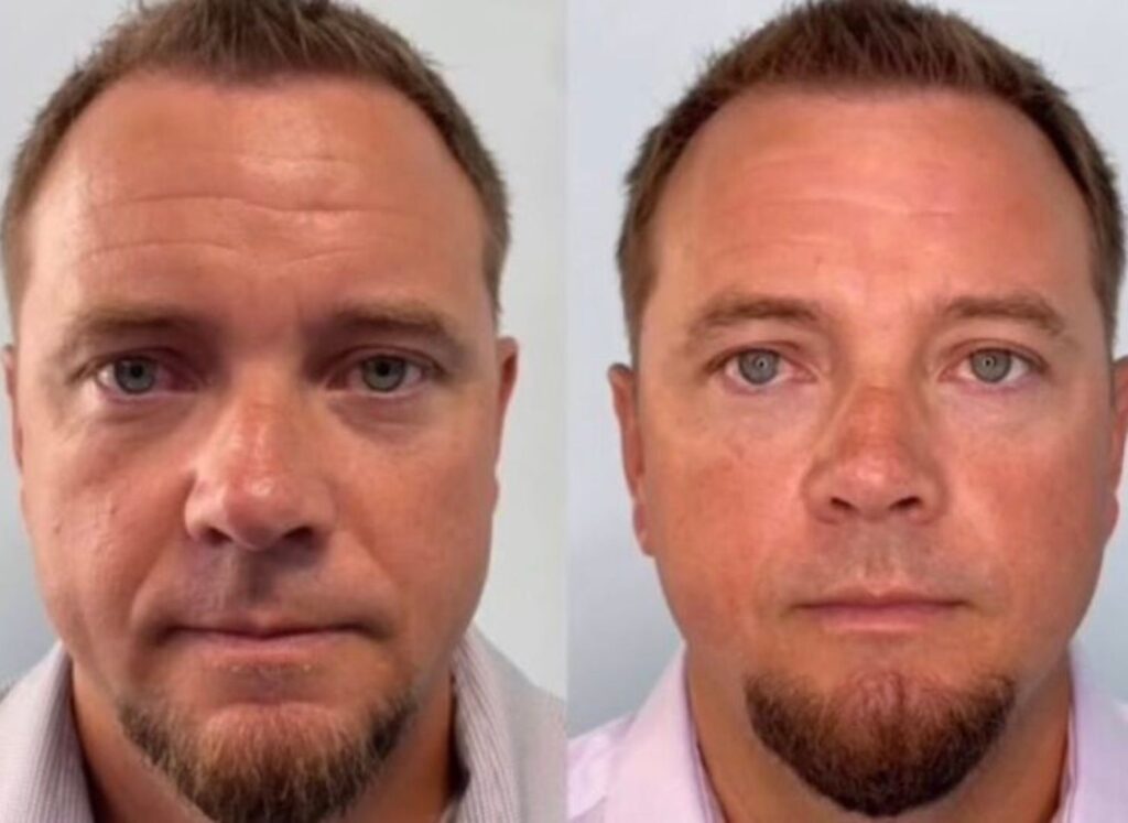 Emface results by Dr. Barbara Rappaport in Jax, FL