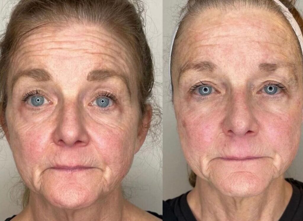 Emface Results by Laurel, Licensed Medical Aesthetician (IG: studiosculptlaurel)
