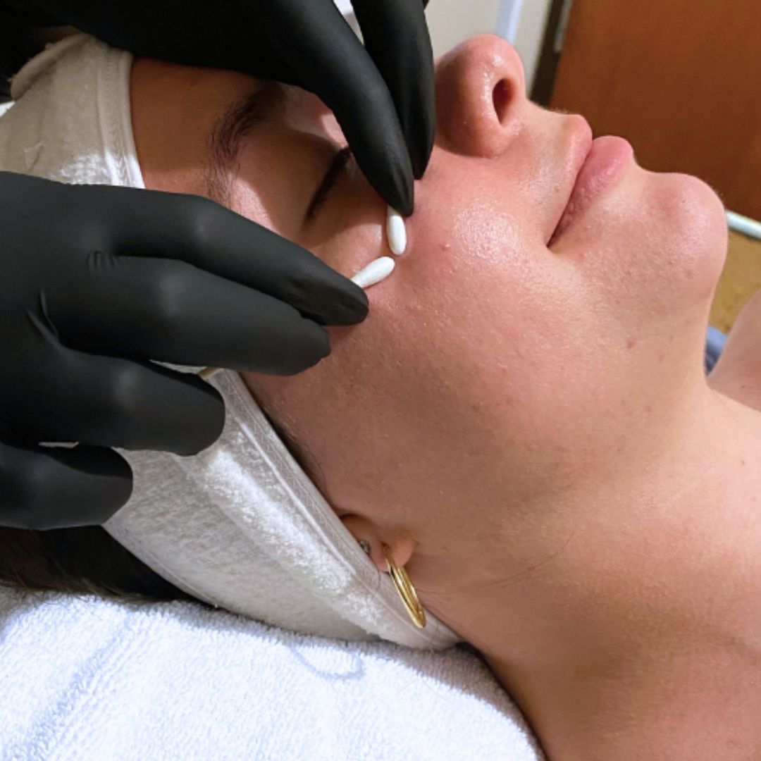 Facial extraction being performed on a woman with gloved hands and cotton swabs.