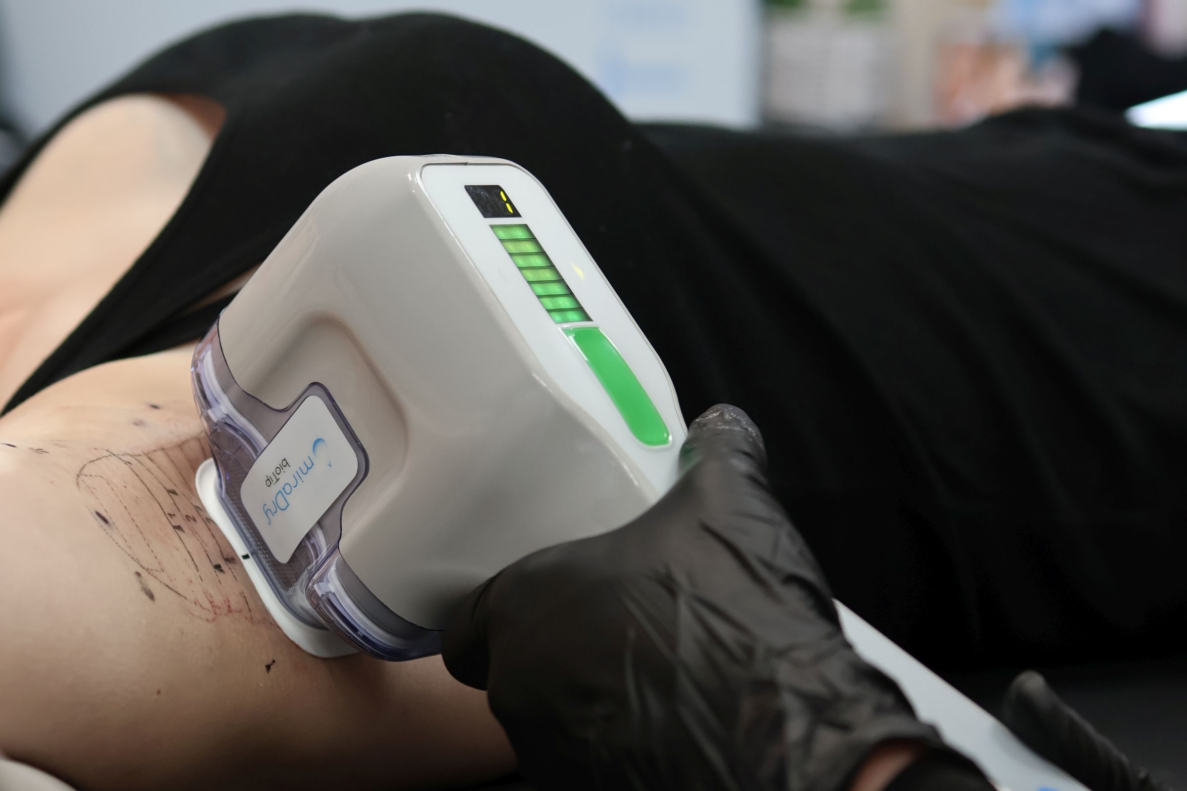 A woman in a black tank top receives miraDry treatment.